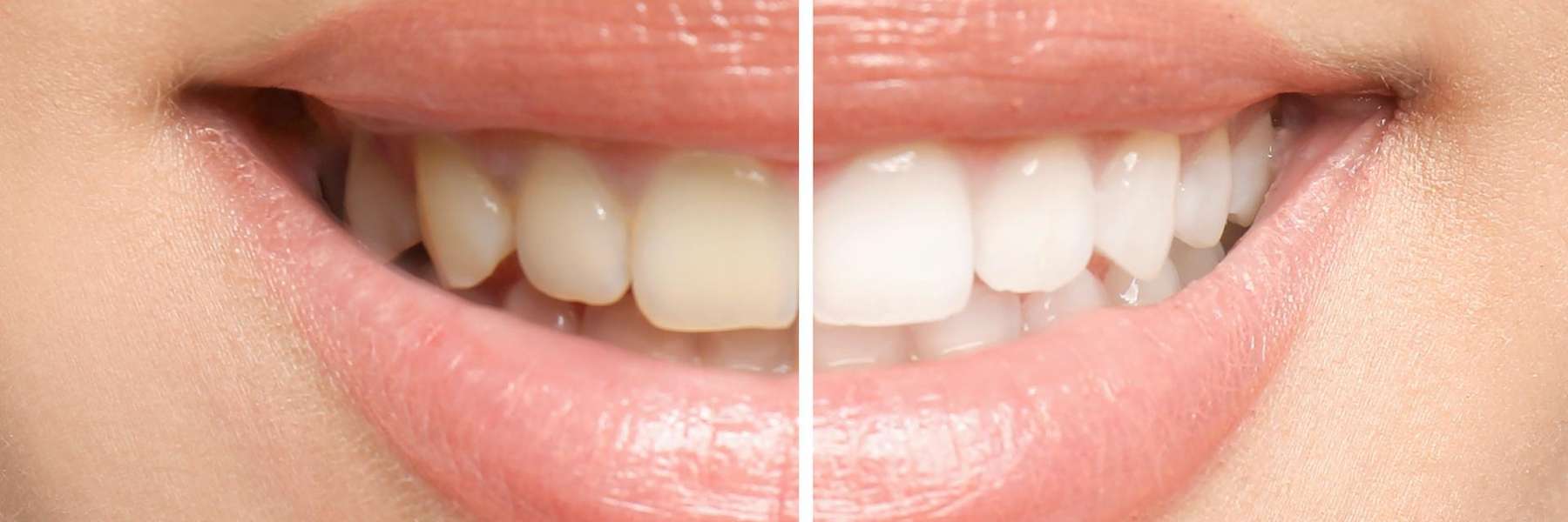 teeth whitening results in burke va