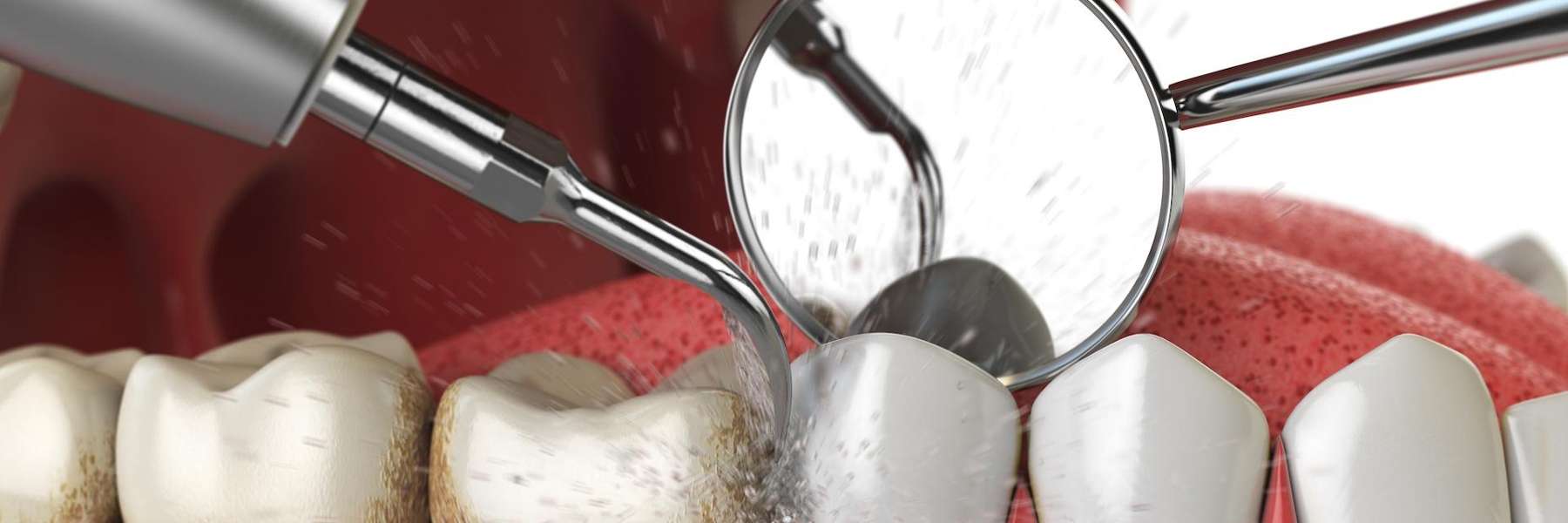 teeth cleaning in burke va