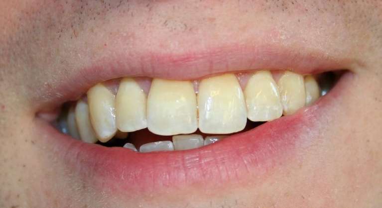 Cosmetic-Dental-Bonding-After-Image