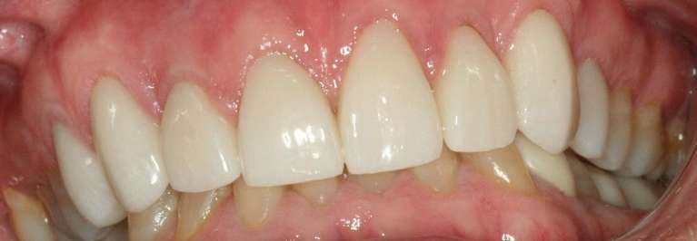 Full-Mouth-Reconstruction-After-Image