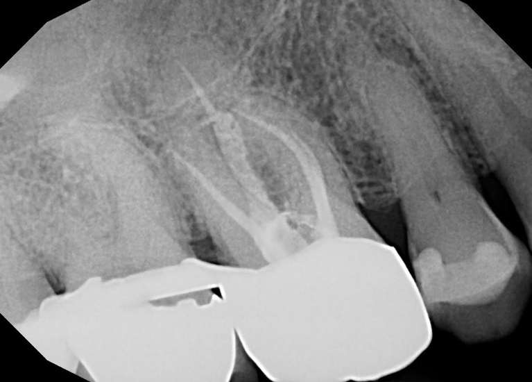 Root-Canal-Treatment-After-Image