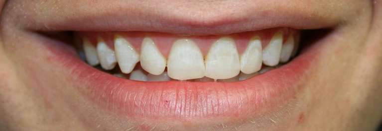 Cosmetic-Contouring-and-Shaping-After-Image