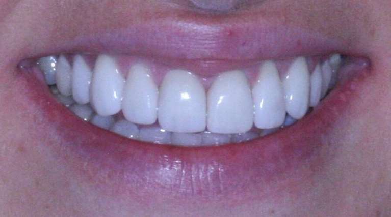 Dental-Veneers-Re-Treatment-After-Image