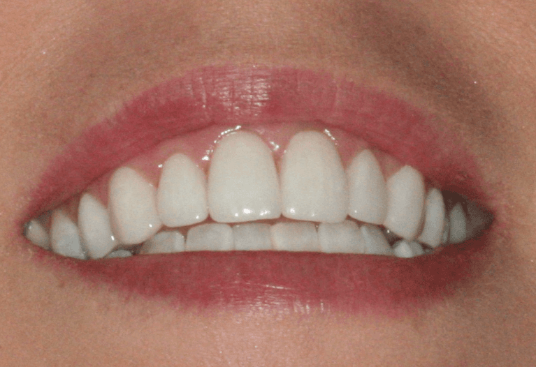 Dental-Veneers-After-Image