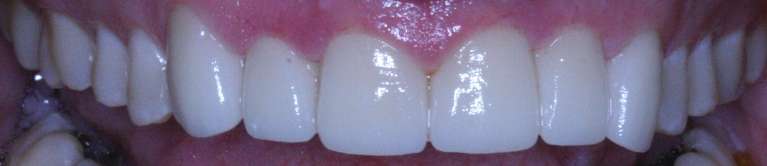Dental-Crowns-for-Aesthetic-Alignment-After-Image