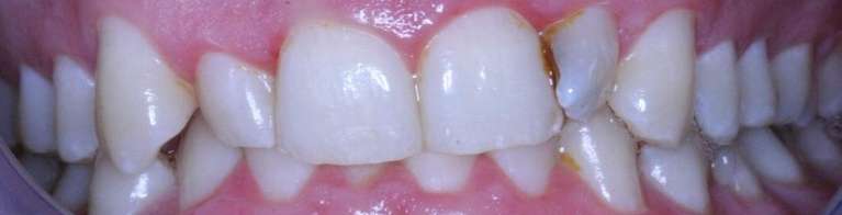 Dental-Crowns-for-Aesthetic-Alignment-Before-Image