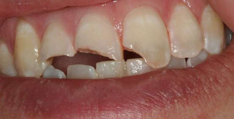 Emergency-to-Repair-Broken-Teeth-Before-Image
