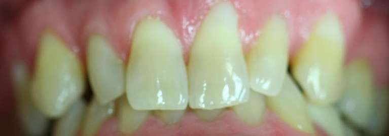 Full-Mouth-Reconstruction-Before-Image