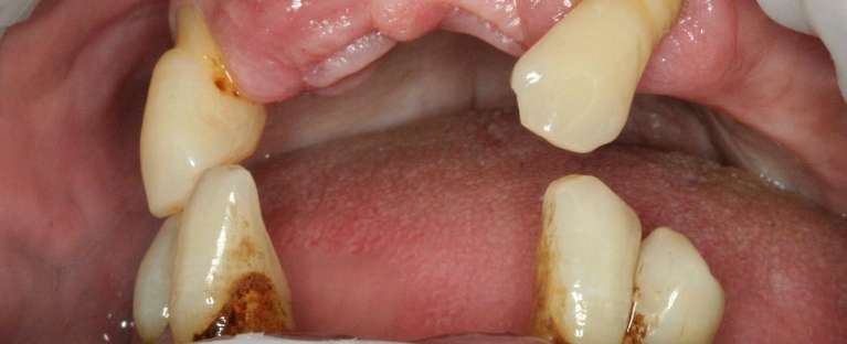 Implant-Reconstruction-Teeth-in-a-Day-All-on-X-Before-Image
