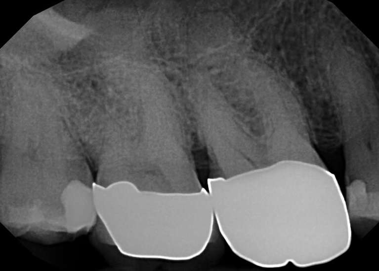 Root-Canal-Treatment-Before-Image