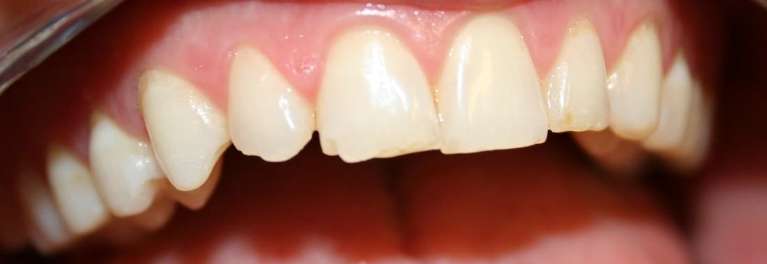 Cosmetic-Contouring-and-Shaping-Before-Image