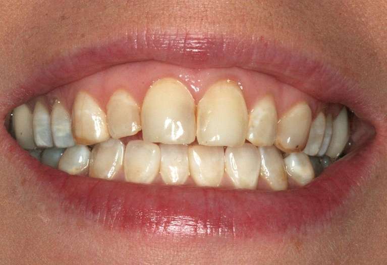 Dental-Veneers-Before-Image