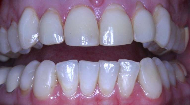 Dental-Veneers-Re-Treatment-Before-Image