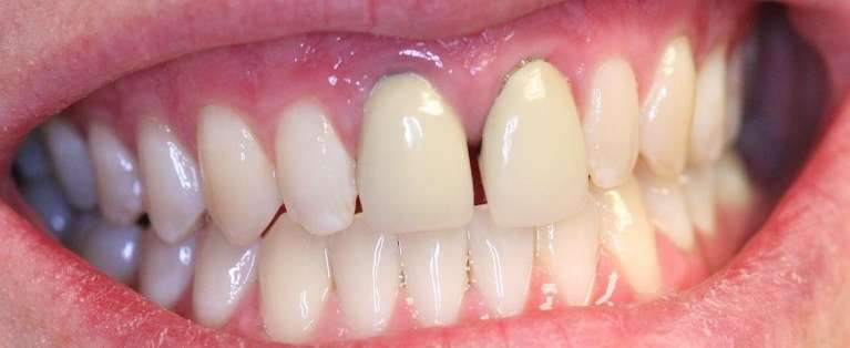 Teeth-Whitening-and-Veneers-Before-Image